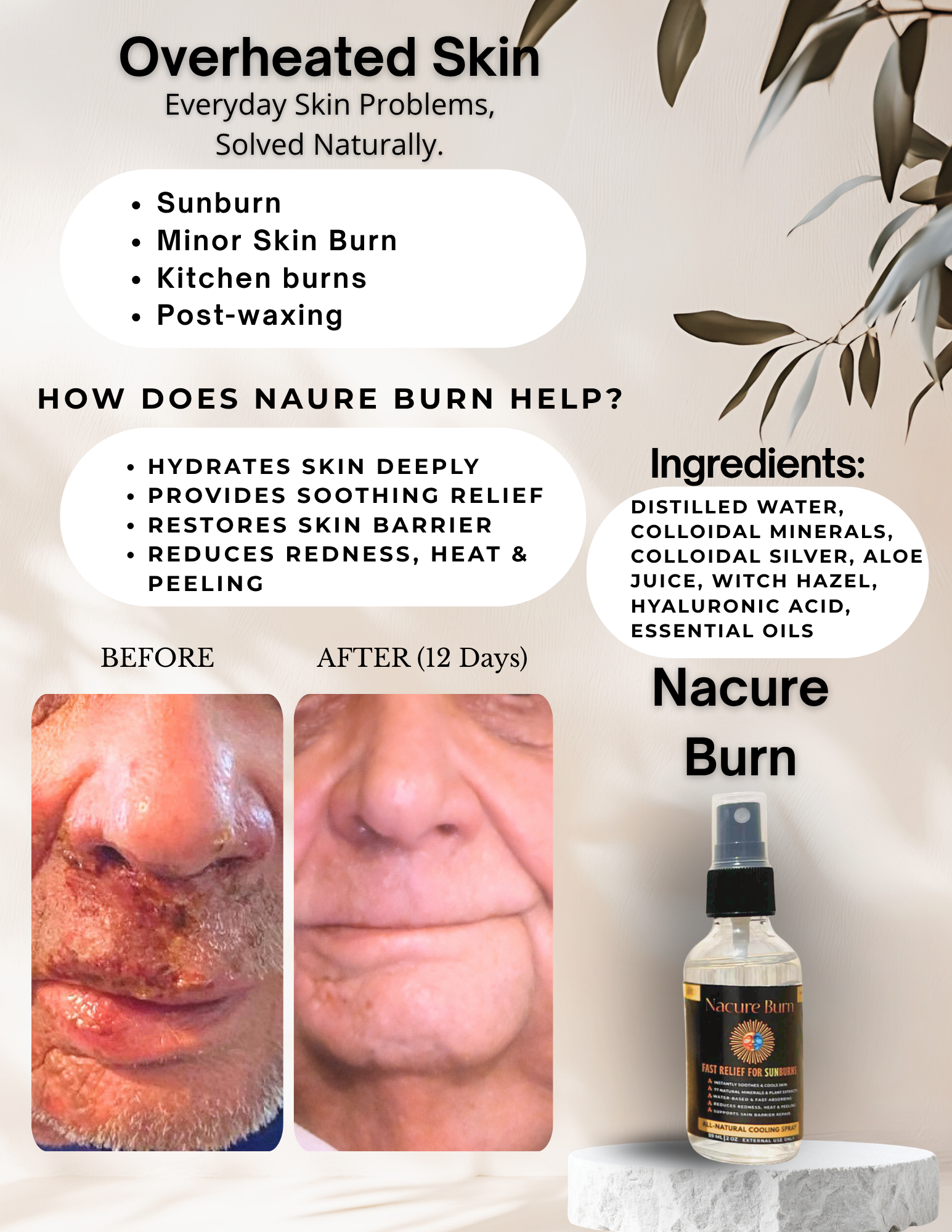 Nacure Burn